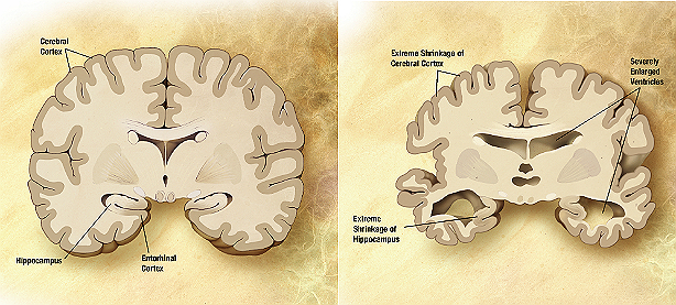 Combination of two brain diagrams in one for comparison. In the left normal brain, in the right brain of a person with Alzheimer's disease