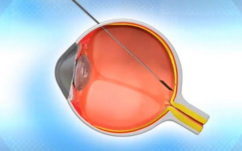 In a procedure lasting no longer than 30 minutes, the implant is attached to the retina.