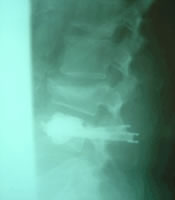 X-ray photo of the implant