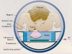 An illustration of the how the ExAblate 2000 works: an ultrasound transmitter inside the waterbed projects a high power beam into the patients body.